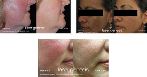 Laser Genesis - Shades Valley Dermatology