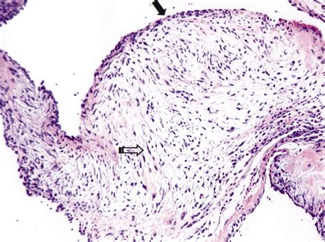 Mitral Valve Histology