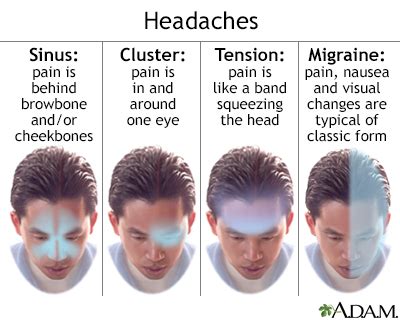 Tension Headache Symptoms, Doctors, Treatments, Advances & More | MediFind