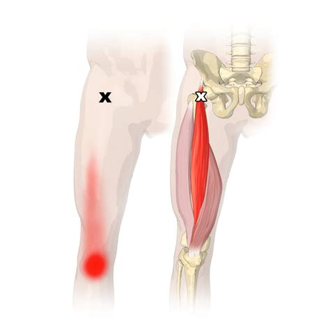 The Rectus Femoris Muscle - Its Attachments and Actions