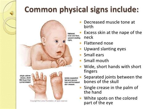 Down syndrome: causes, symptoms, diagnosis, and treatment - Fashions ...