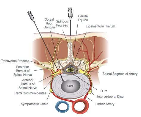 Epidural Steroid Injection — EPIC PAIN MGMT (973)866-0336