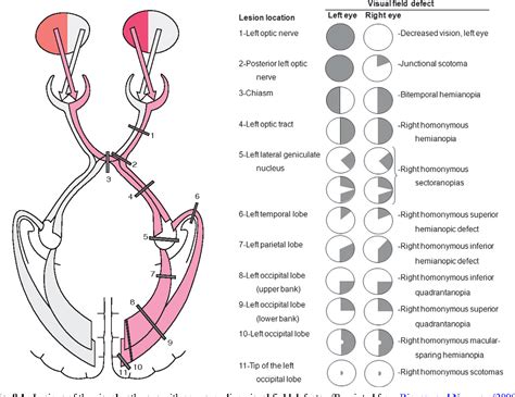 Disorders of the optic tract, radiation, and occipital lobe. - Semantic ...