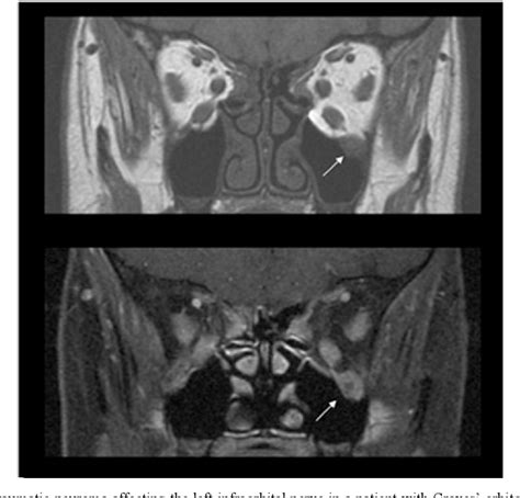 Figure 1 from Orbital decompression in Graves’ orbitopathy: state of ...