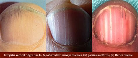 Vertical ridges in fingernails: causes, aging & health related variations!