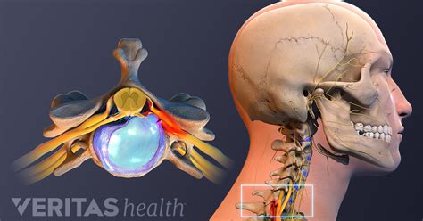 Herniated Disc Symptoms