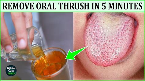 Oral Thrush In Adults Home Treatment