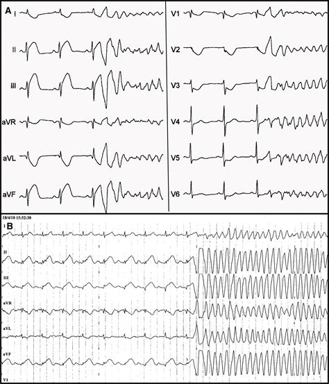 Ventricular Flutter Vs Torsades