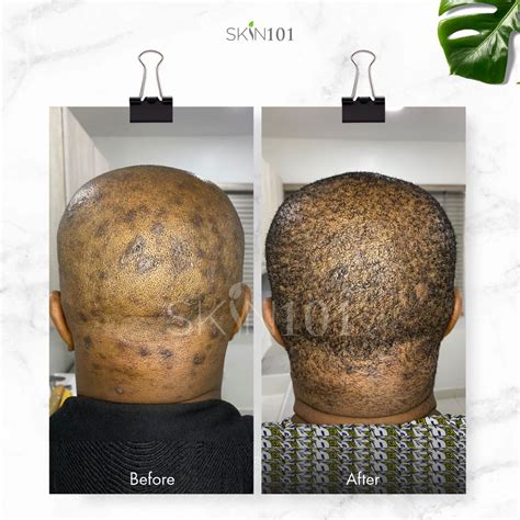 Scalp Folliculitis Treatment Before And After - AWARD-WINNING DOCTOR ...