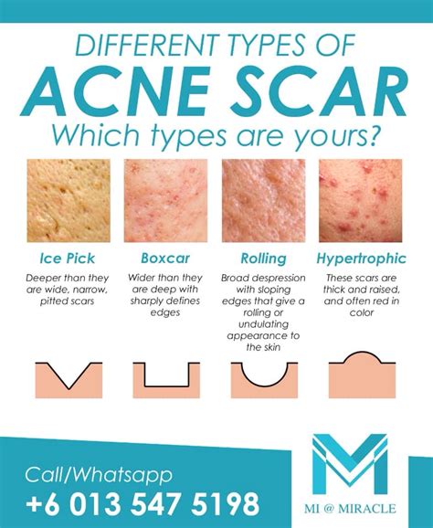 Acne Scar Removal | Miracle Skin Laser & Aesthetic Centre