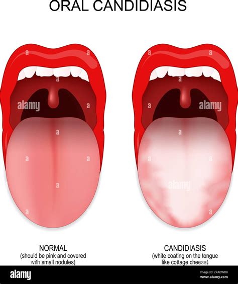 oral candidiasis. difference and comparison of healthy mouth and tongue ...