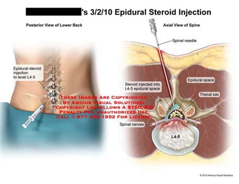 Epidural Steroid Injection - Greg's Area