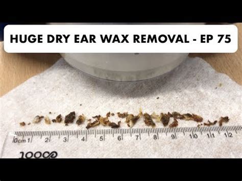 Dry Ear Wax