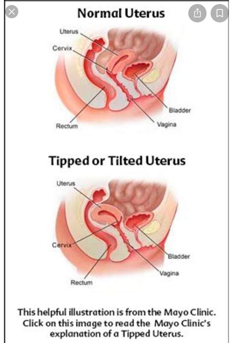 Inverted Uterus Diagram