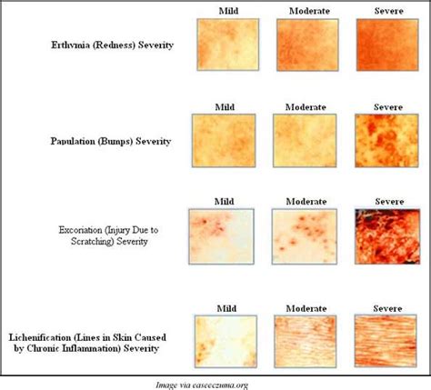 atopic dermatitis treatments - pictures, photos