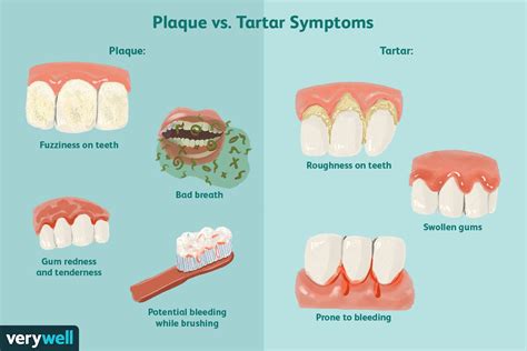 Plaque Removal and Preventing Tartar Buildup