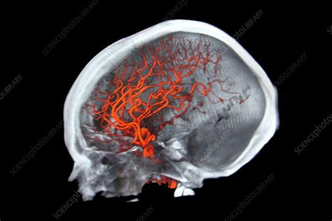 Brain aneurysm, CT angio scan - Stock Image - C003/7271 - Science Photo ...