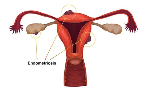 Some Common Endometriosis Symptoms – ccsonoma