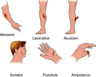 Types & Causes of Open Wounds | Wounds nursing, Nursing school survival ...