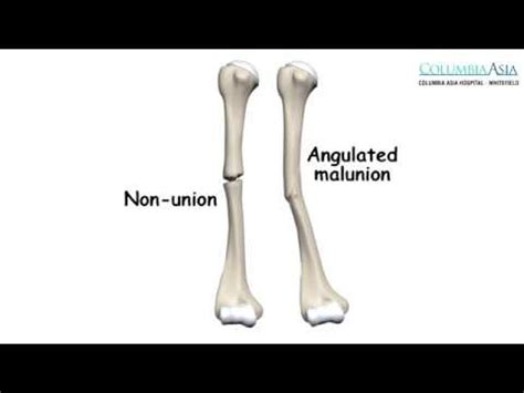 How are Non-Union & Malunion of Fractures managed? - YouTube