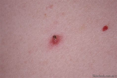 dermal nevus - pictures, photos