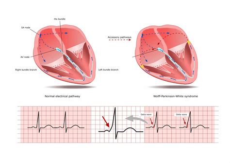 WPW Heart Ae