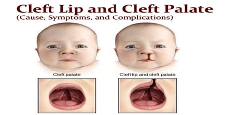 Cleft Lip and Cleft Palate (Cause, Symptoms, and Complications ...