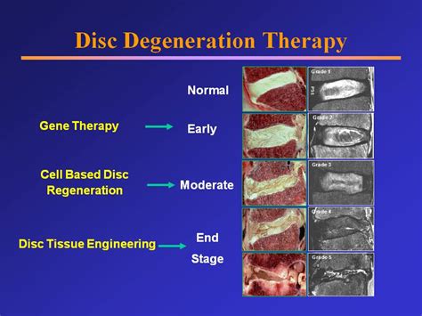 Disc Degeneration Therapy - Joshua Li, MD, PhD