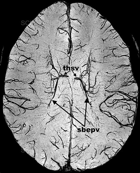 Photograph | Brain, MRI | Science Source Images