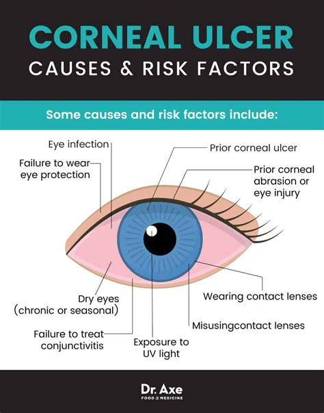 Corneal Ulcer Symptoms + Relieve Symptoms 11 Natural Ways - Dr. Axe