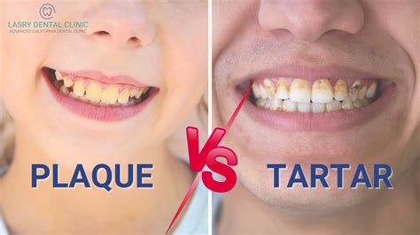 Plaque vs. Tartar and How To Remove Them At Home