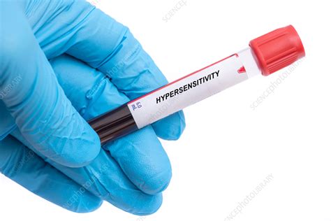 Hypersensitivity blood test - Stock Image - F042/0695 - Science Photo ...