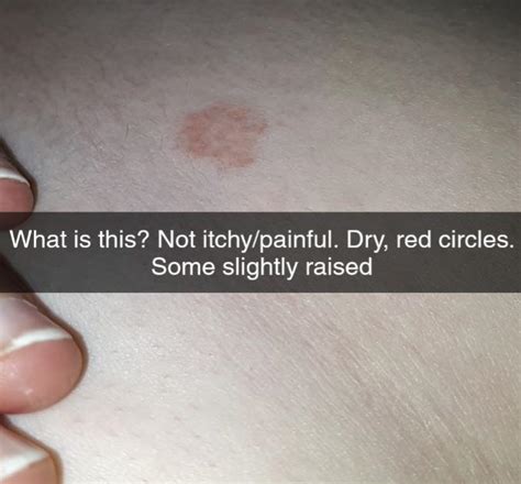 Small Red Dry Patches All Over My Body Slightly Raised Not Itchy Or