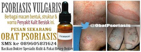 Penyakit Kulit Psoriasis – newstempo