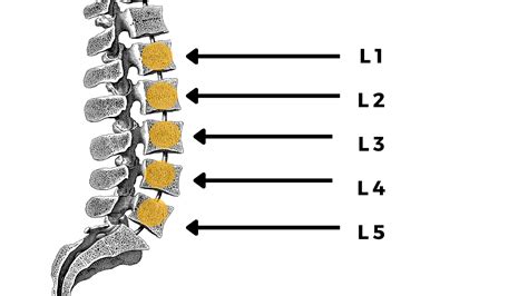 Lumbar L5-S1 disc herniation