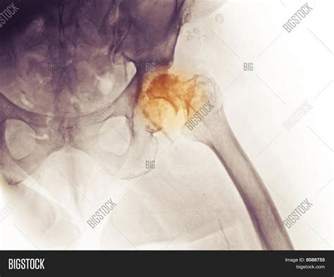 X-ray Hip Fracture Image & Photo (Free Trial) | Bigstock