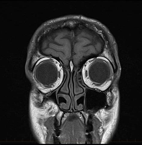 Mri Scan Nhs Mri Scan Brain Scan Mri Brain Images