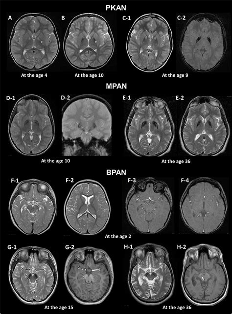 Abnormal Brain MRI Results