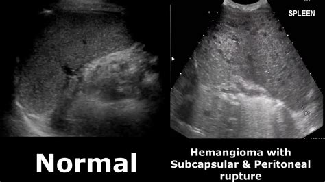 Abnormal Spleen Ultrasound