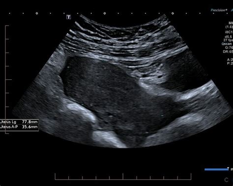 Ruptured Ectopic Pregnancy Ultrasound