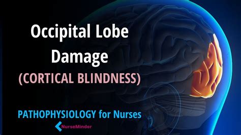 Cortical Blindness: Occipital Lobe Damage Nursing Pathophysiology in a ...