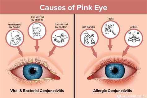 Pink Eye (Conjunctivitis) Causes - All About Vision