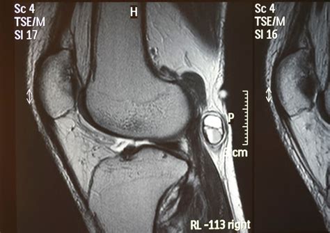 Joint & Knee MRI - Insight Medical Imaging