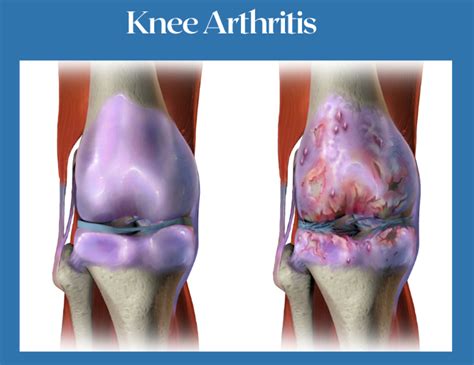 Can you regrow knee cartilage? YES - In just minutes a day ...