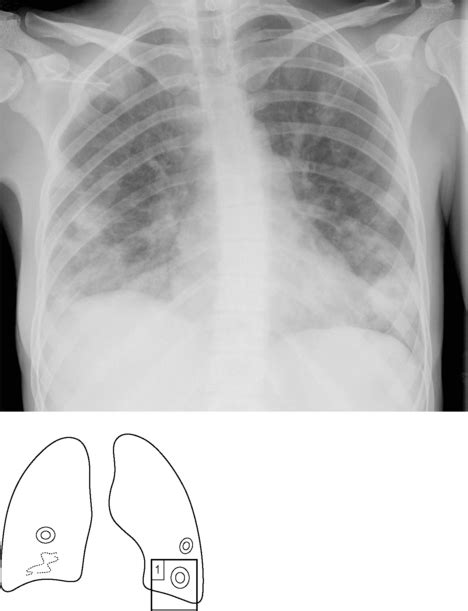 Lung abscess | Radiology Key