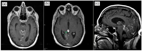 (a and b) Axial T1-post-contrast gadolinium MRI of the brain, which ...