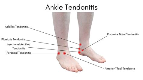 Ankle Tendonitis: Learn what causes Ankle Tendonitis