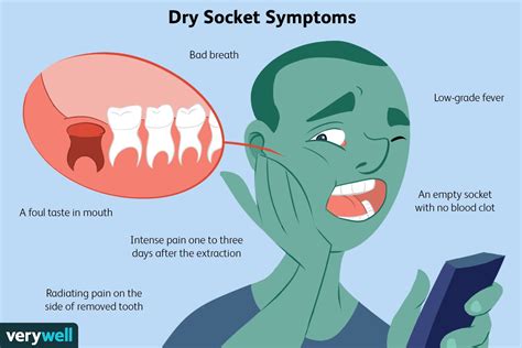 Neat Info About How To Avoid Dry Socket After Tooth Extraction ...