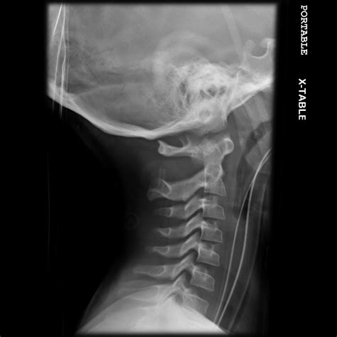 Female abnormal cervical spine x ray - holfgenerator