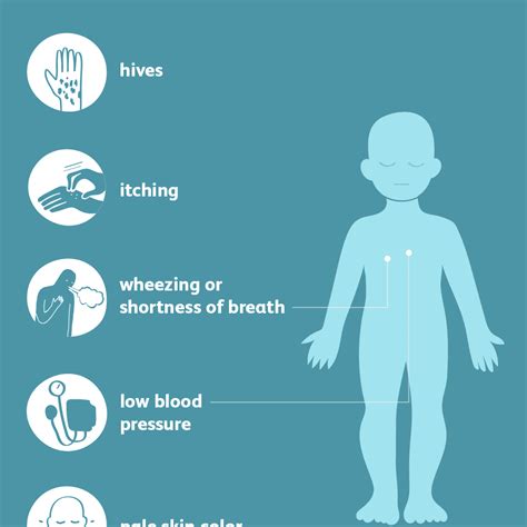 Anaphylaxis Symptoms - Anaphylaxis - Tower Allergy : The symptoms are ...